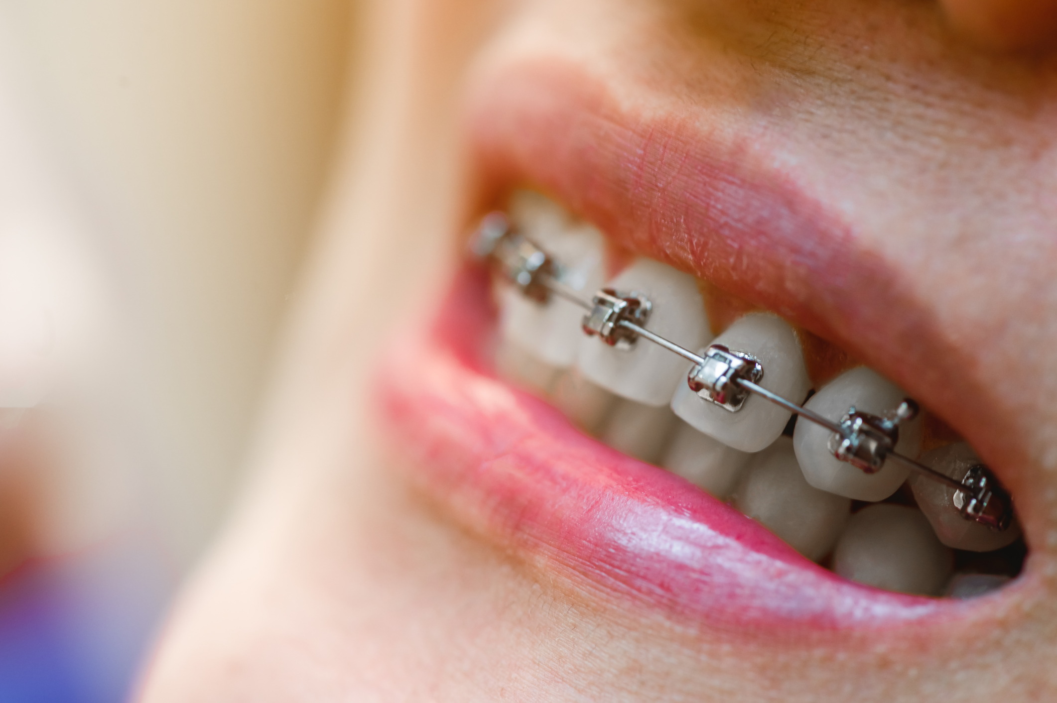 Self-ligating braces from White Mountain Orthodontics